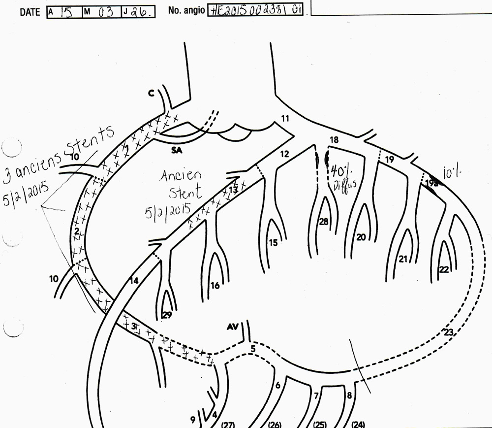 Coronarographie de Benoit l'Heureux, qui montre les blocages et les Stents insérés par le cardiologue-hémodynamicien.